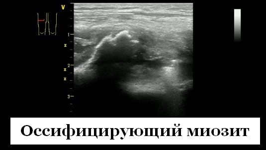 uzi myshtsy bedra ossifikatsiya